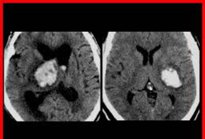 Manejo del ACV en la Emergencia