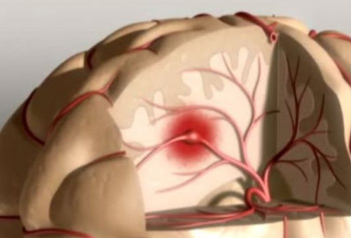 Accidente Cerebro Vascular Isquémico