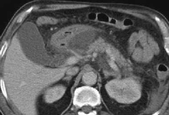 Curso de Imagenología. Tomografía Computada de Abdomen Agudo